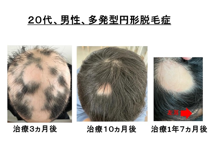 円形脱毛症　病院